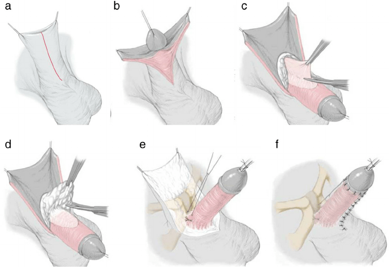 Ligamentotomía para agrandamento do pene